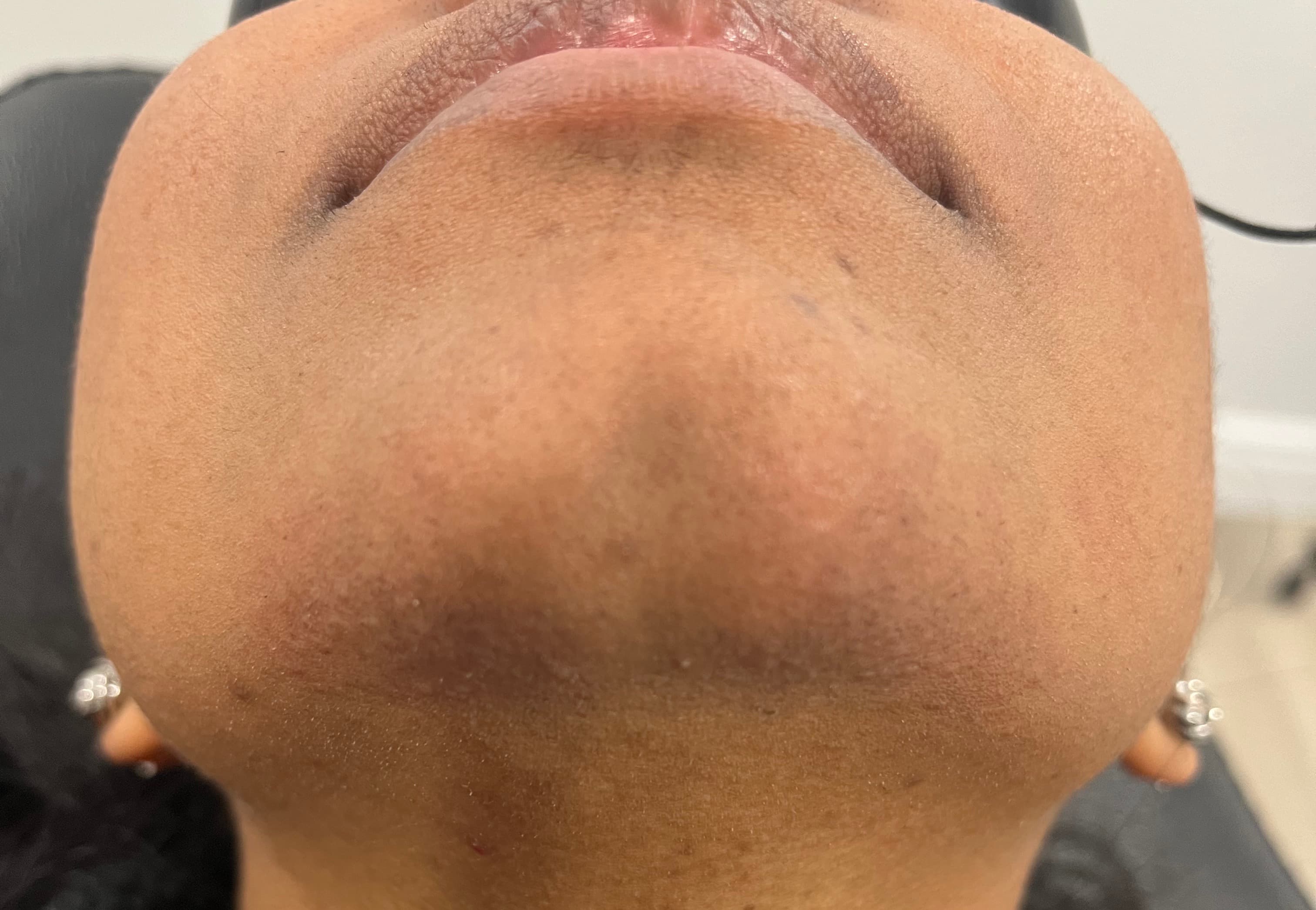 Chin - Hair Removal — after
