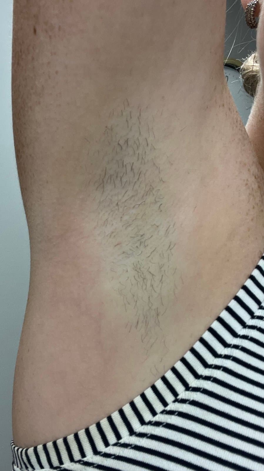 Underarms — before
