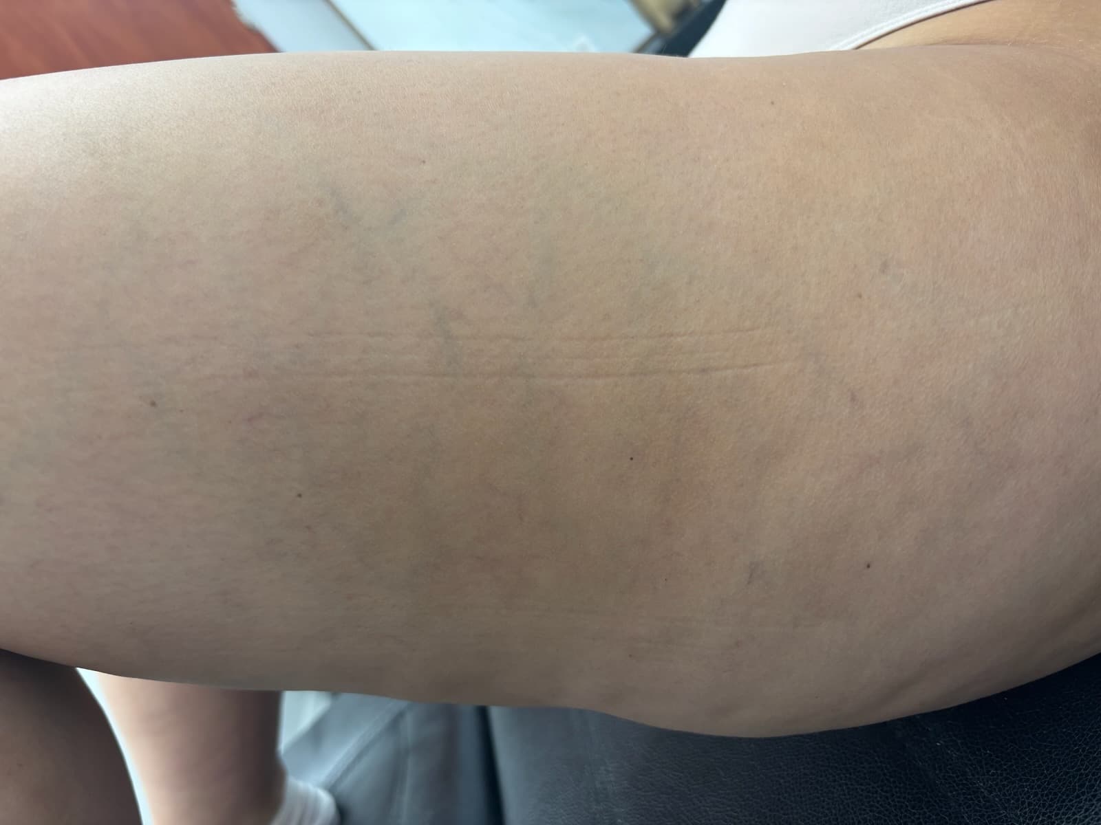 Spider Vein Removal — after