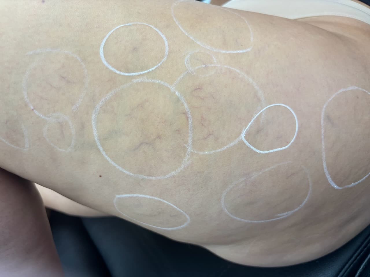 Spider Vein Removal — before