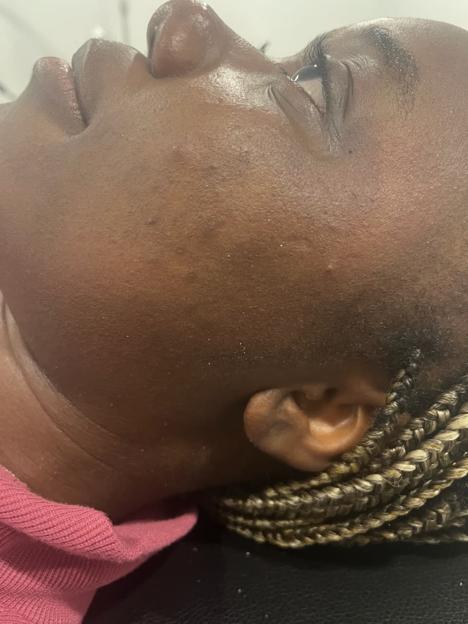 Microdermabrasion Facial — after