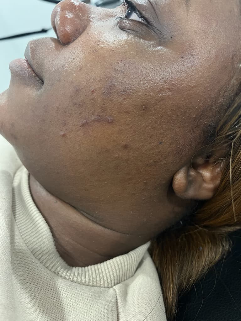 Microdermabrasion Facial — before